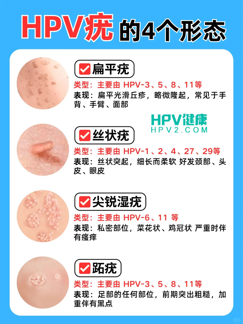 HPV疣的4个形态！.jpg