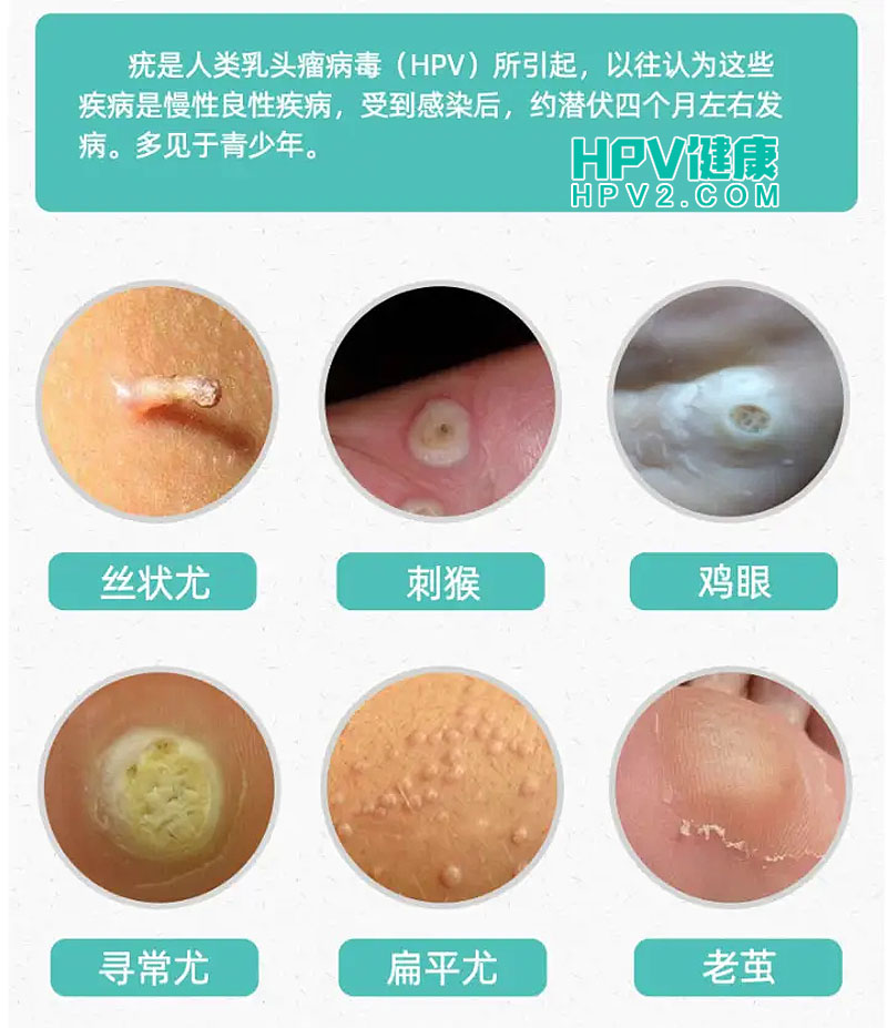 月嫂身上的疣是否具有传染性？如何判断我和孩子是否被传染？.jpg