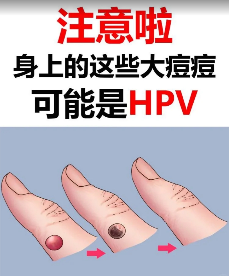 别忽视！身上的这些小痘痘，有可能是HPV！.png