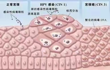 到‮哪底‬个年龄的‮性女‬容易感染HPV患宫颈癌.jpg