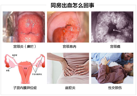 性生活出血是什么原因.jpg