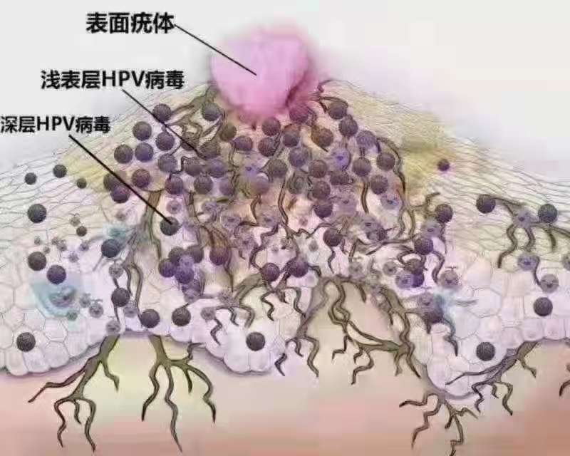 HPV病毒感患染‬者，为什么一‬定要清除体内的HPV病毒.jpg