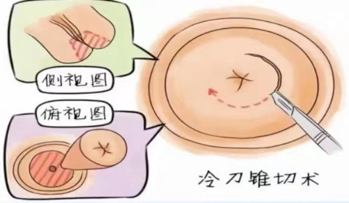 冷刀与利普刀的优缺点.jpg
