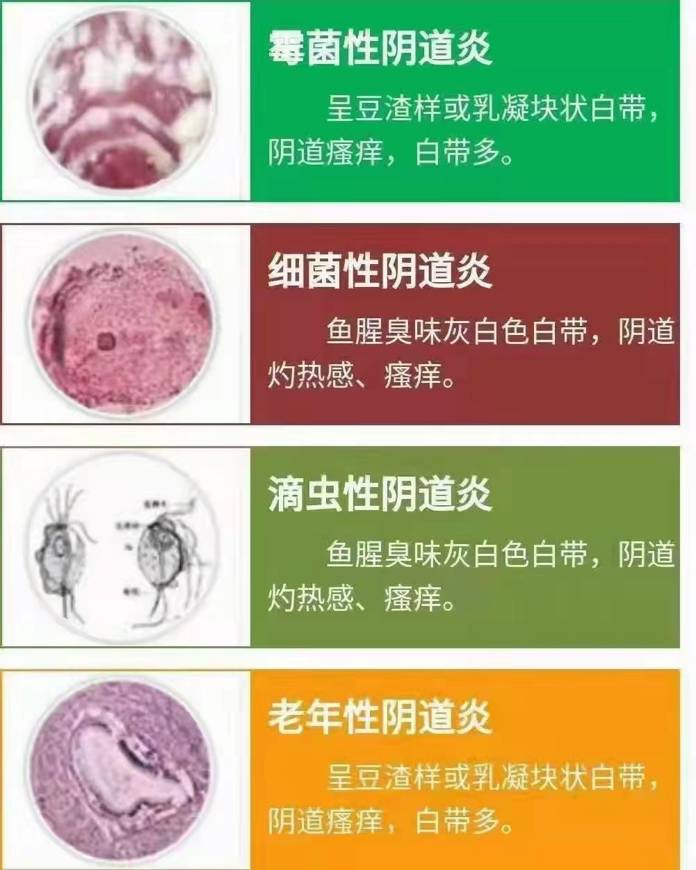 阴道炎的分类及症状.jpg