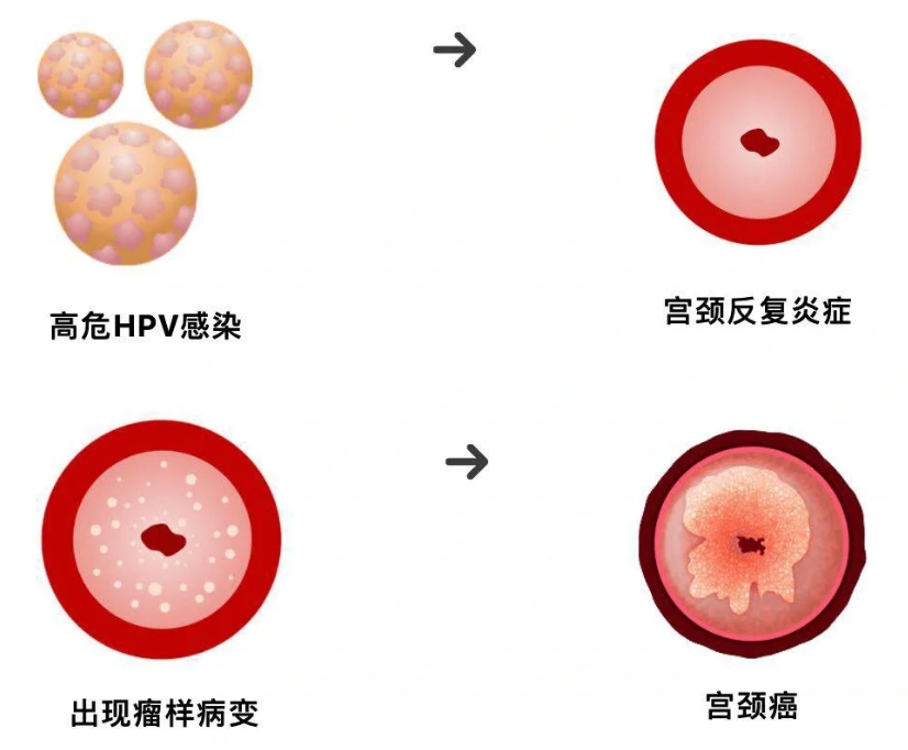 HPV感染到底要不要做阴道镜.png