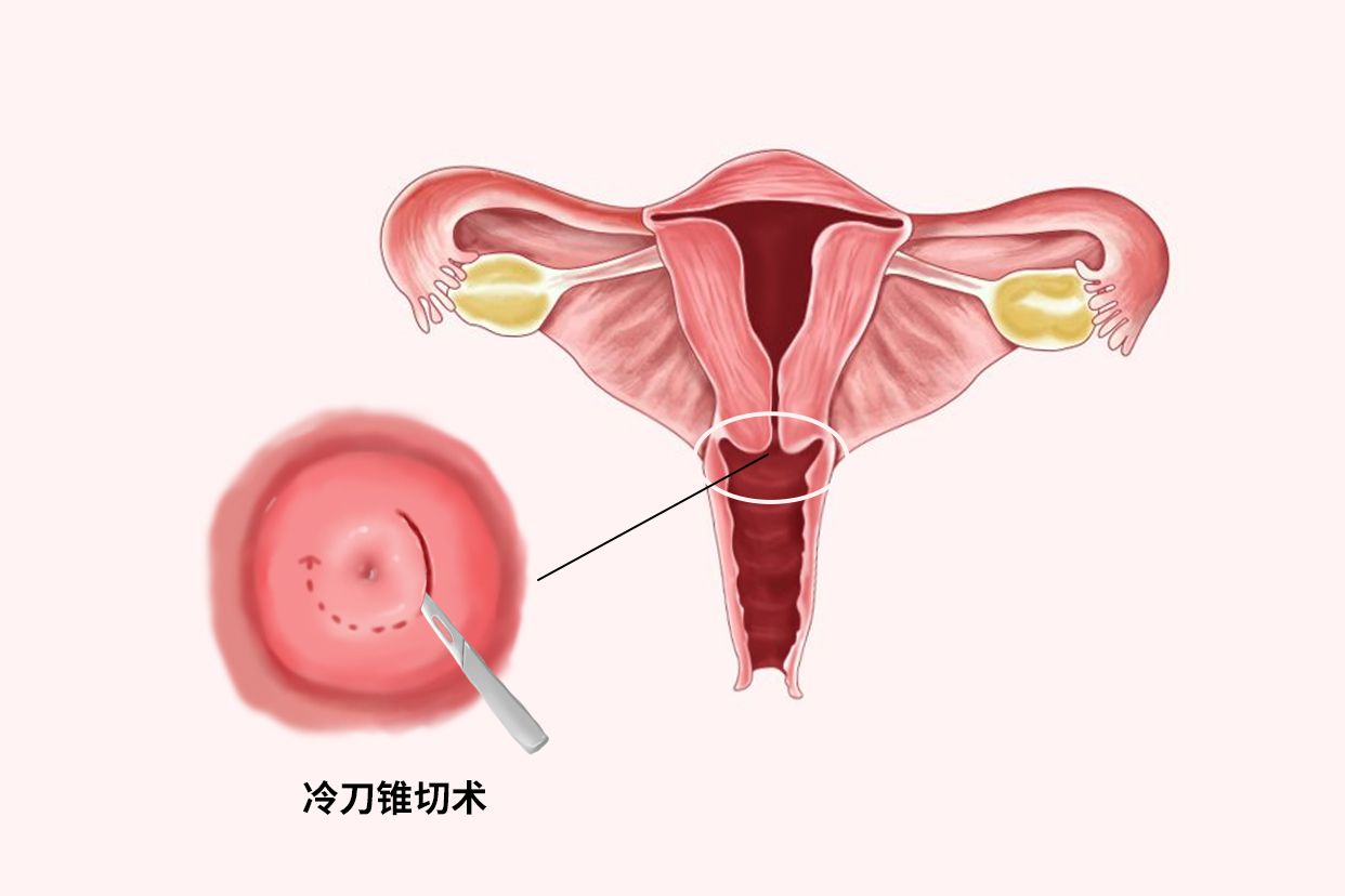 为什么说锥切要慎重.jpg