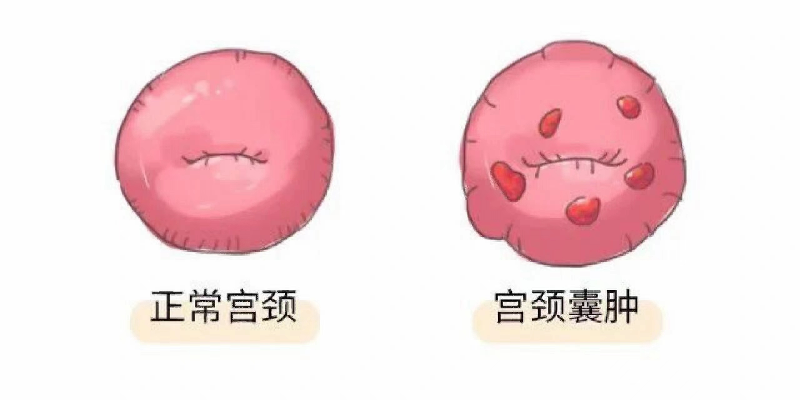 宫颈纳囊是怎么产生的.jpg