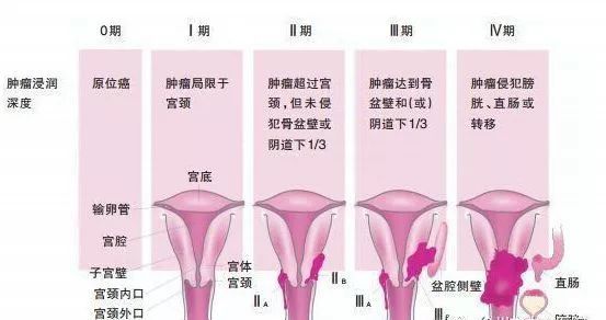 宫颈癌如何分期.jpeg