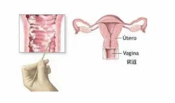 为什么女性容易得阴道炎.jpg