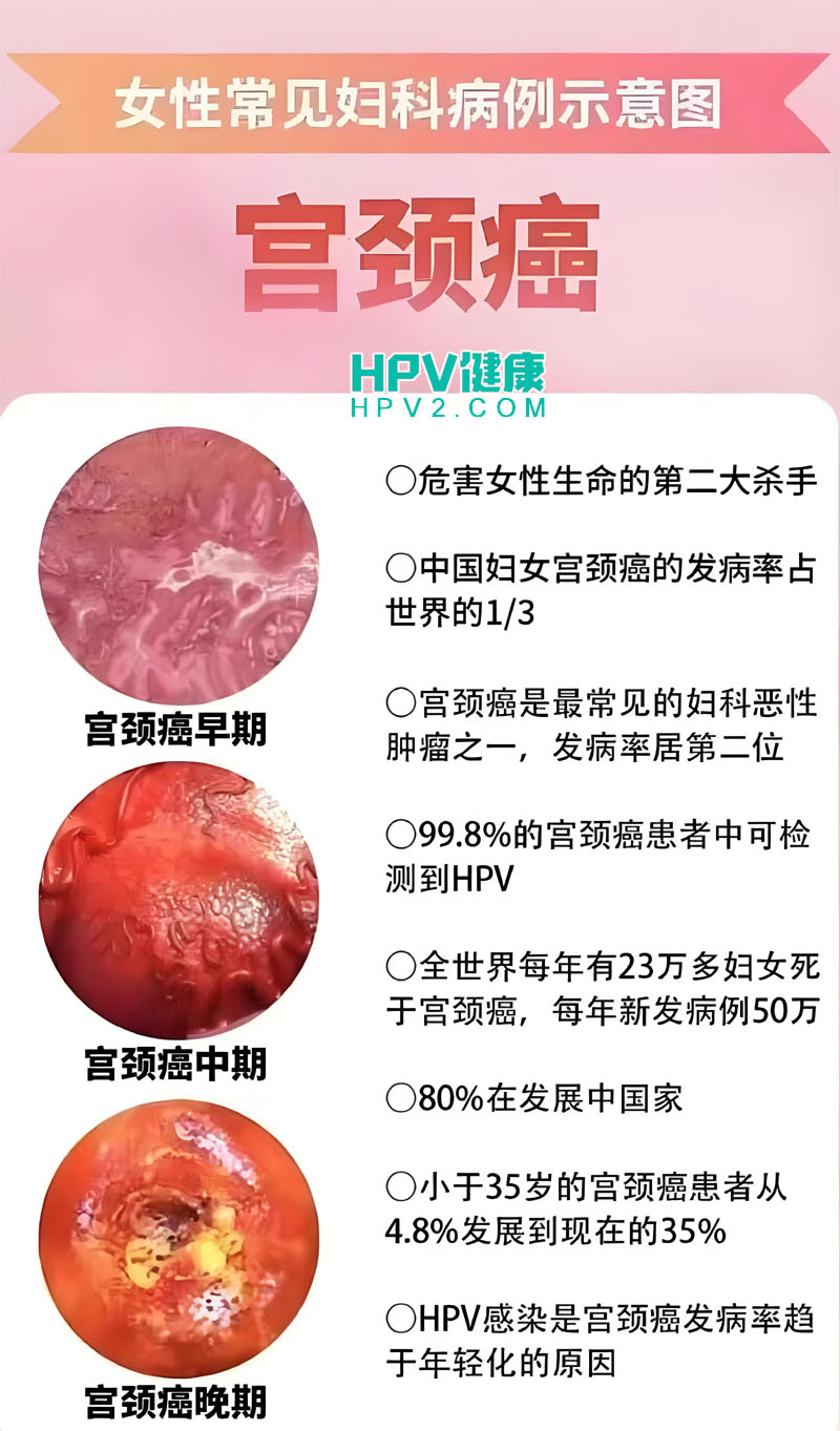 宫颈癌筛查取样方法揭秘：为何不用棉签？.jpg