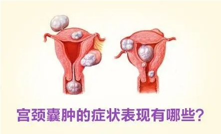 宫颈潴留性囊肿，是什么病.png