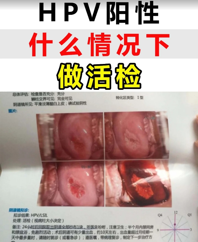 HPV阳性什么情况下做活检.png