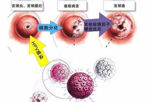 高危型HPV病毒会发展成几个阶段.jpeg