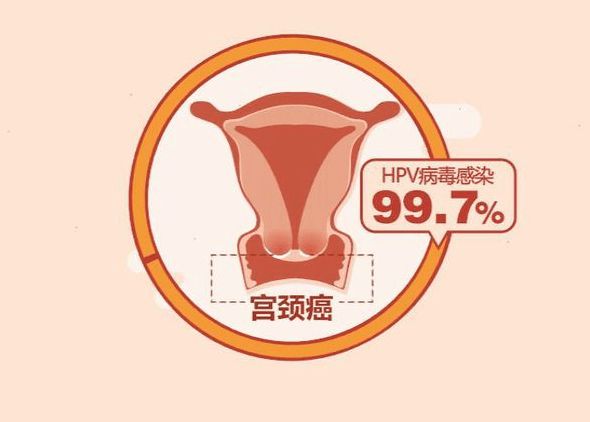 HPV感染患者中哪些更容易发展为宫颈癌.jpg