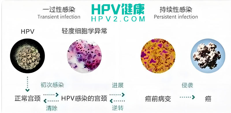 【女性健康】揭秘HPV持续性感染与自愈可能性.jpg