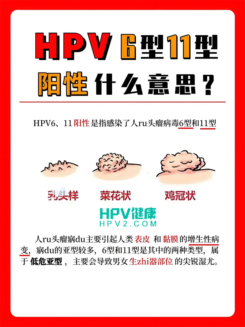 HPV6和HPV11阳性：低危型HPV感染的治疗与生活建议.jpg