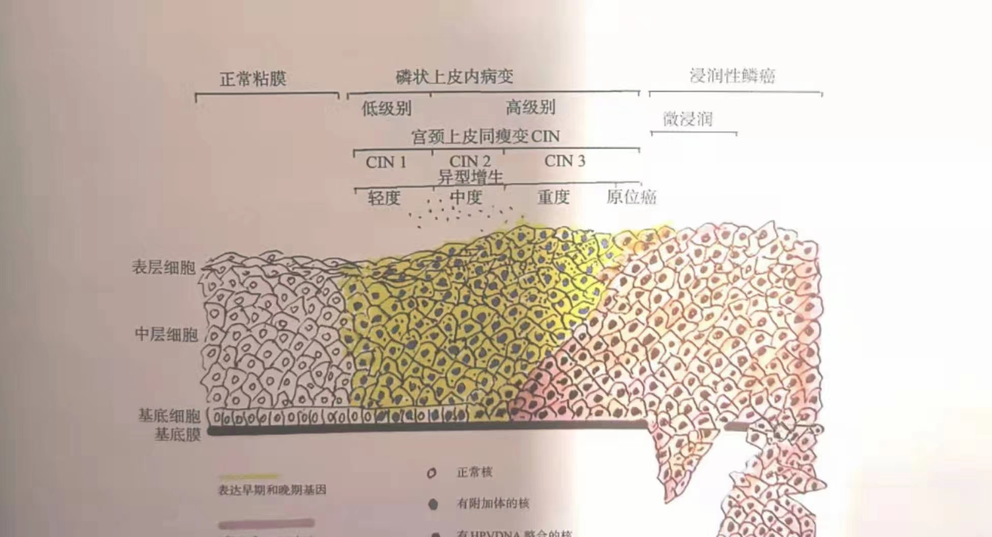 宫‮病颈‬变的发‮过展‬程.jpg