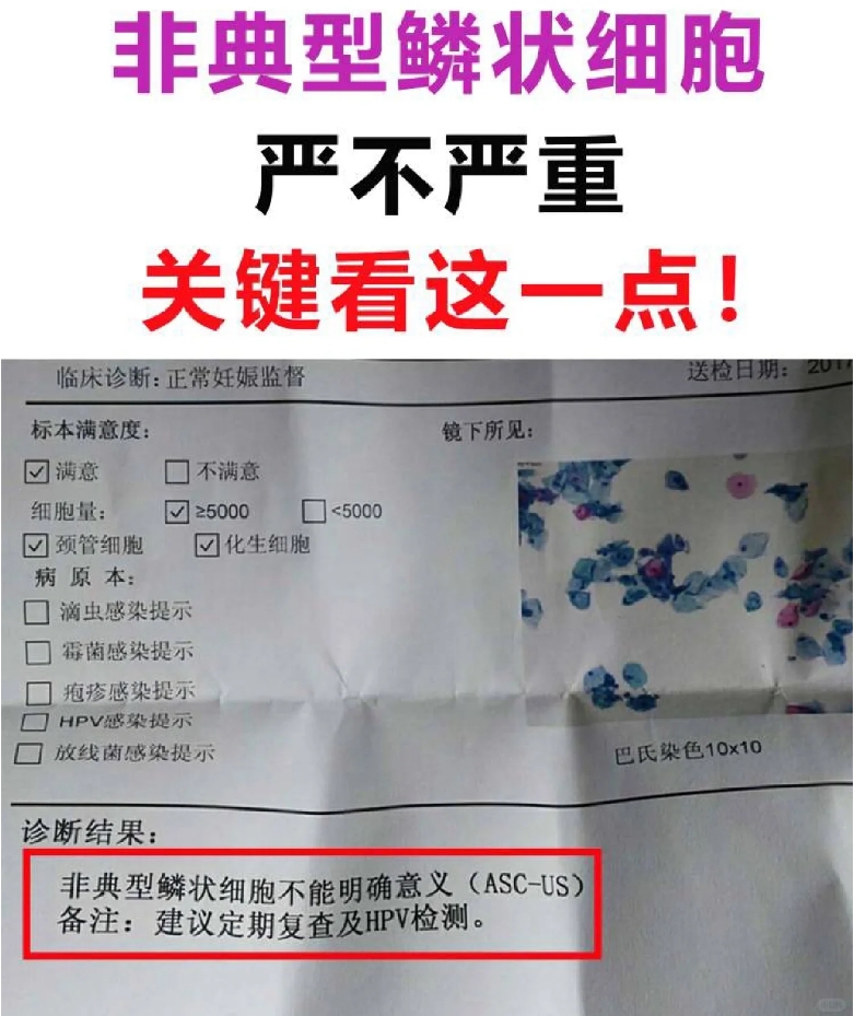 非典型鳞状上皮细胞到底严不严重.png
