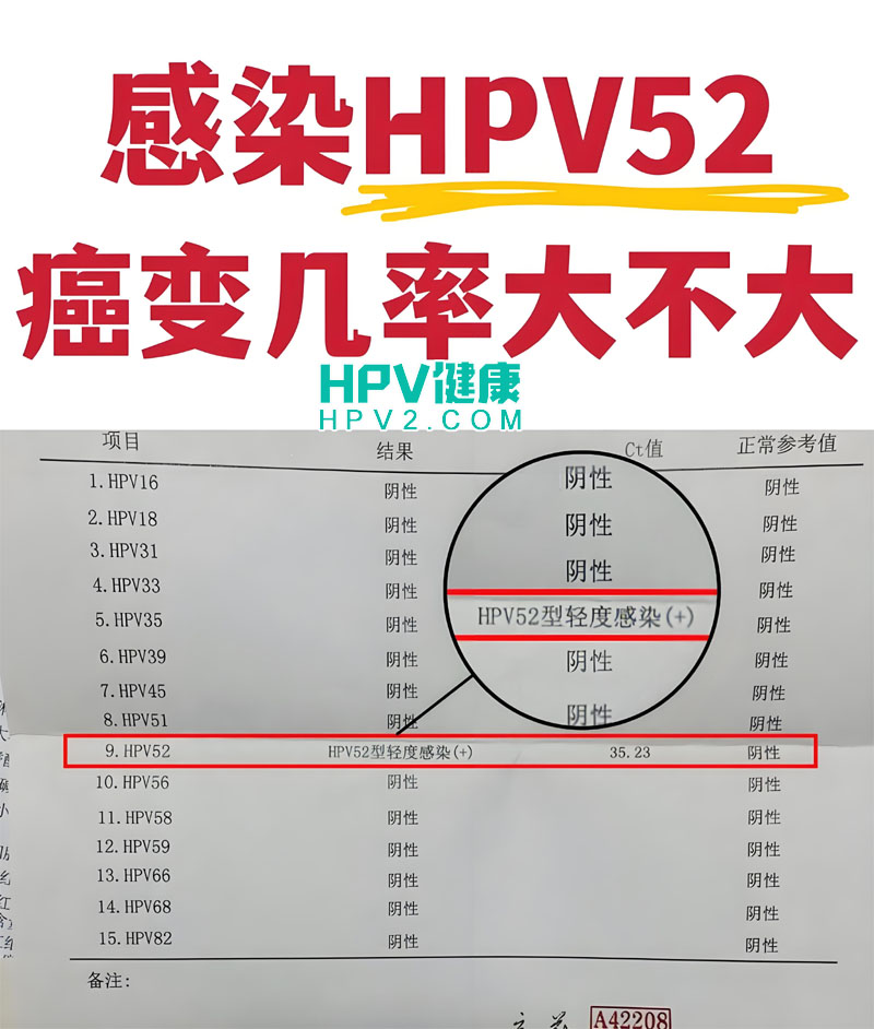 HPV52阳性感染来源探究：是否由伴侣传染？.jpg