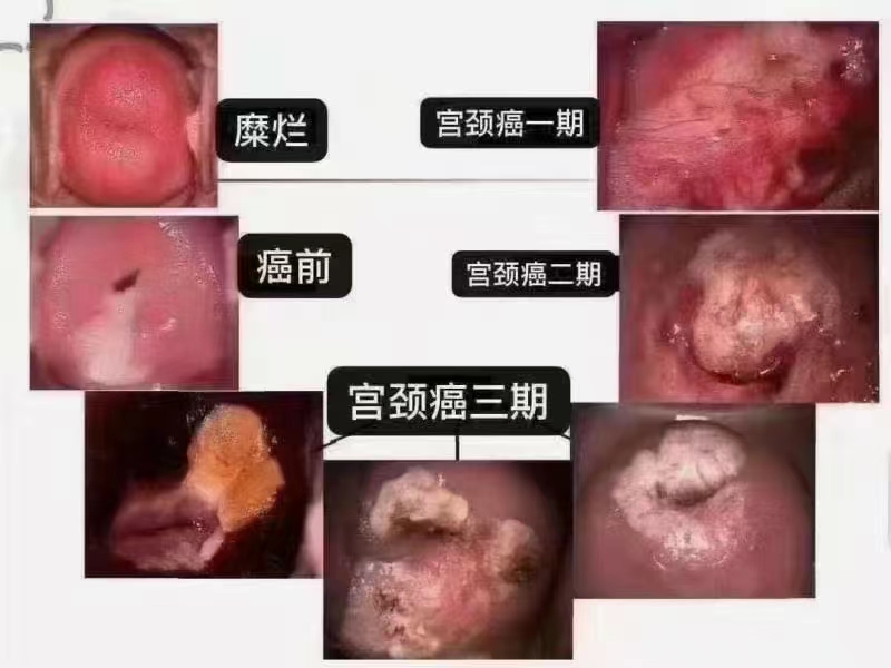 HPV持续感染有什么‬后果？.jpg