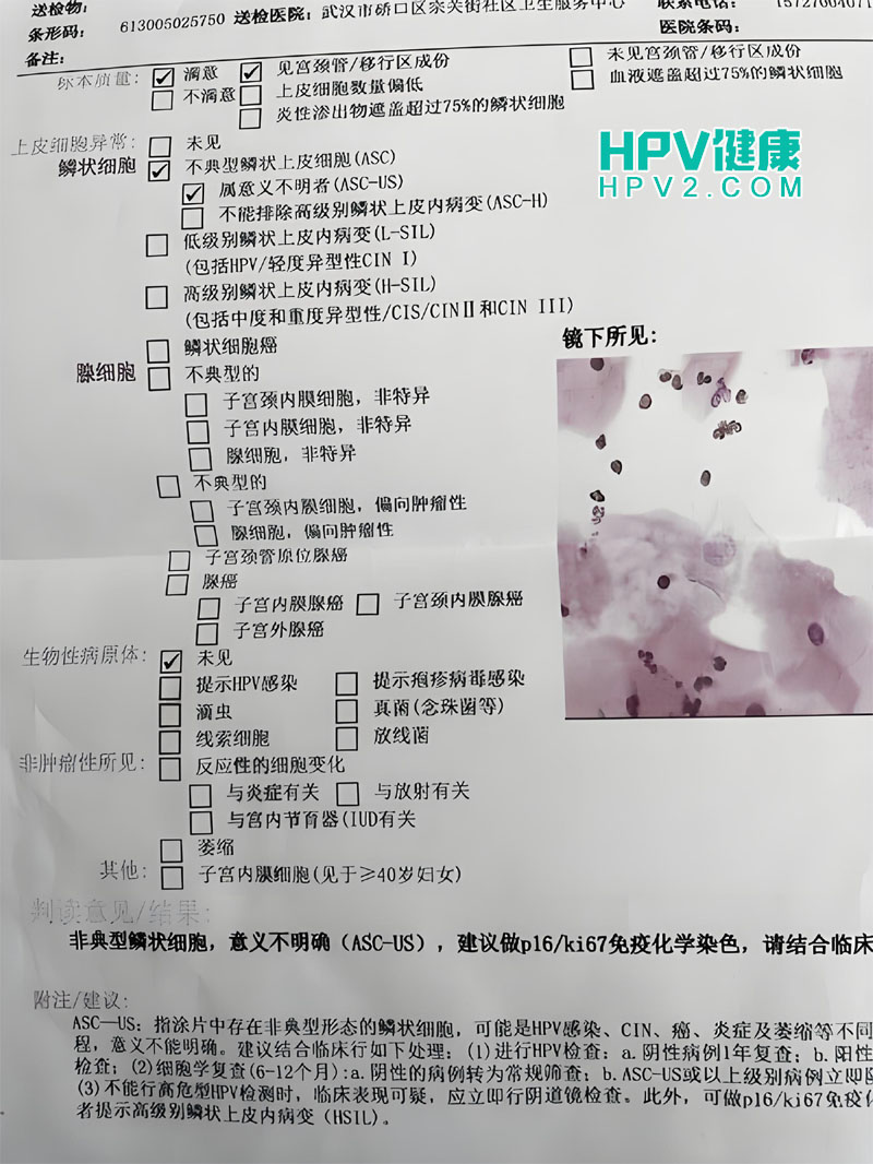 【宫颈筛查解读】揭秘“不明确意义非典型鳞状上皮细胞”的含义.jpg
