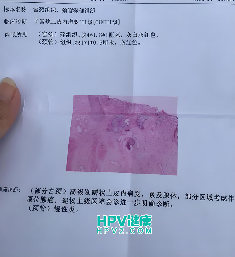 宫颈癌早期癌栓现象解析：这是否正常？.jpg