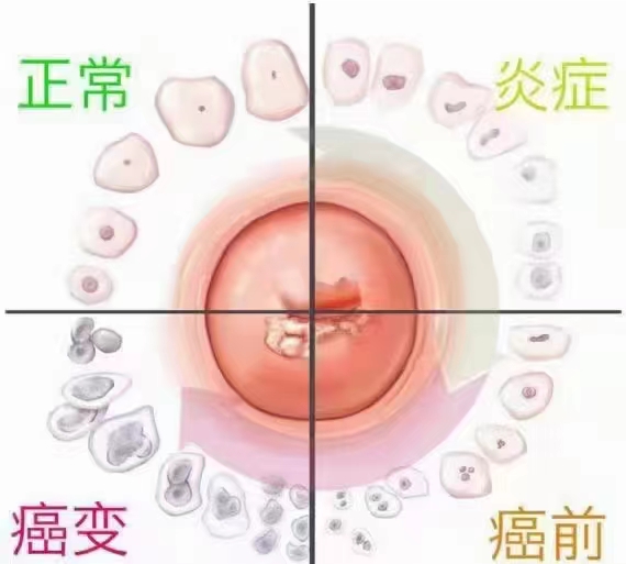 如何有效防范宫颈癌？.jpg