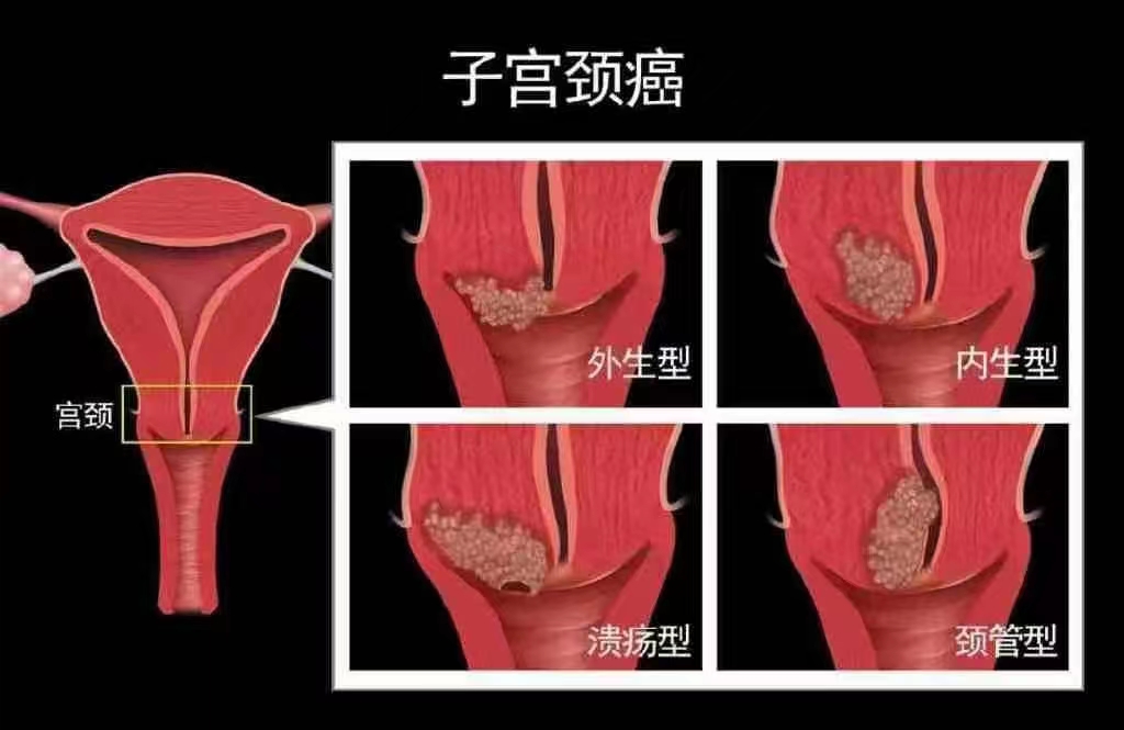 宫颈发生癌变的早期信号.jpg