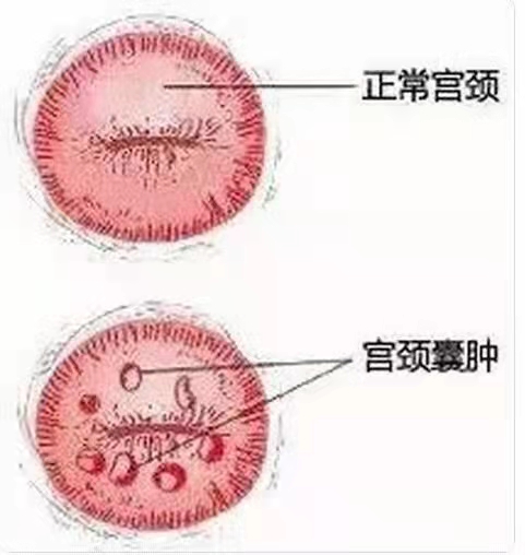 纳囊---长在宫颈上的青春痘.jpg