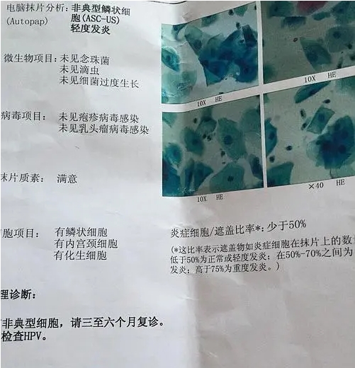 什么是非典型鳞状细胞.png