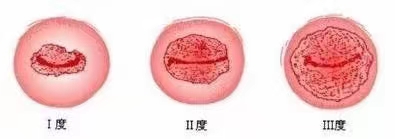 怎么分辨宫颈糜烂的症状？.jpg